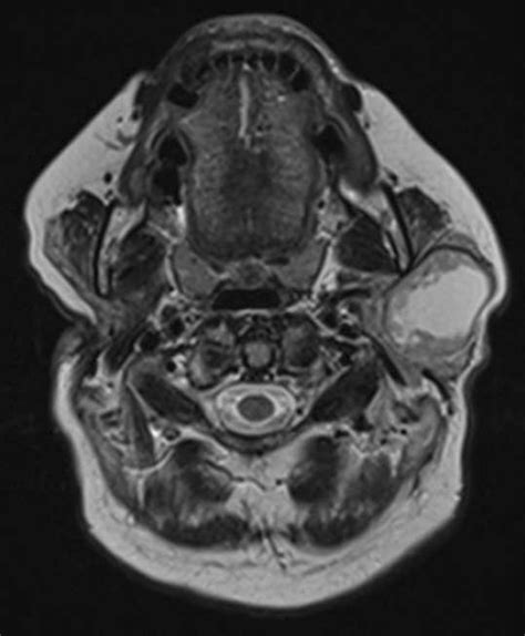 Axial T2 Weighted Mri Image Post Right Total Parotidectomy Presenting A