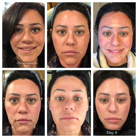 The Perfect Derma Peel Worcester Ma
