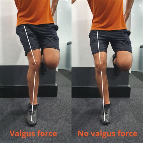 What Is Valgus Collapse Knee Valgus Explained Infinite Health Physio