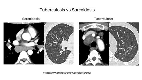 Tuberculosis Vs Sarcoidosis Lecture