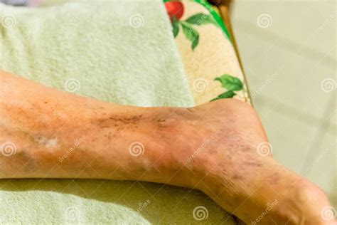 Foot Of Elderly Woman With Phlebitis Stock Image Image Of Health