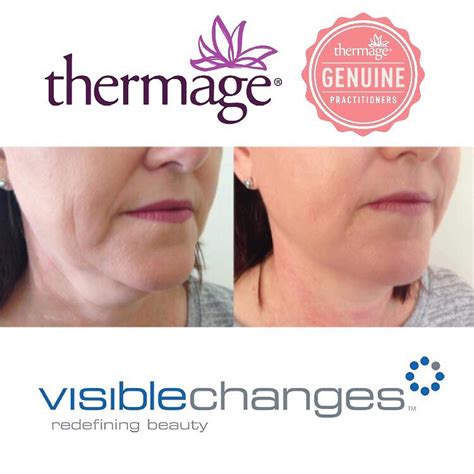 Skin Laser And Cosmetic Clinic Adelaide Visible Changes