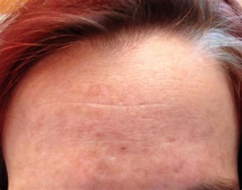 Hole In Middle Of Forehead Scar Treatments Forum