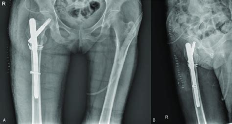 Postoperative Anteroposterior And Lateral Radiographs Of The Right Hip
