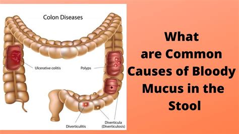 What Are Common Causes Of Bloody Mucus In The Stool Youtube