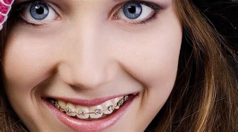 Can Adults Wear Braces Here Are The Facts