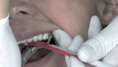 Eating these foods can cause pain if they poke the gum and may start bleeding again. The 'Can Opener' Technique - Spear Education