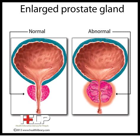 Prostate Gland Diagram Labeled