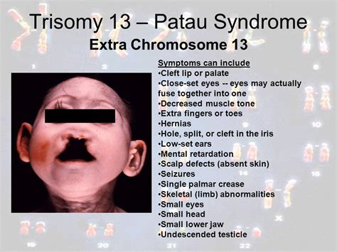 Trisomy 13 On Emaze