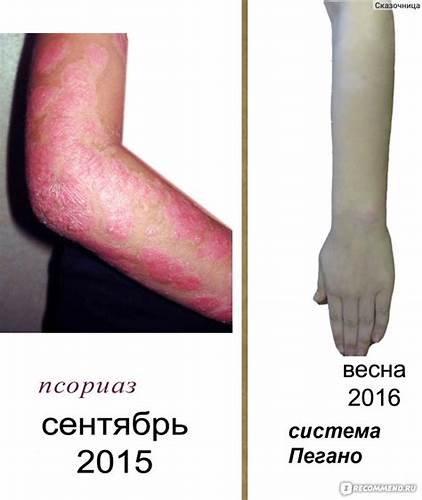 Псориаз диета по Диета по Пегано для больных псориазом - «Псориаз или пройдет или не Диета по Пегано для больных псориазом - «Псориаз или пройдет или не Псориаз диета по
