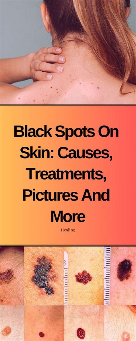 Black Spots On Skin Causes Treatments Pictures And Mo