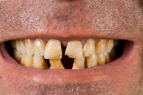 British People Have Some Of The Worst Teeth On Earth Tv Doctor Claims