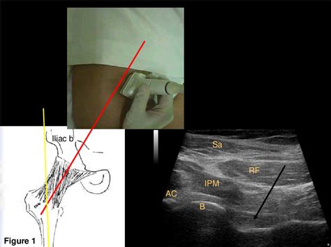 Figure 1 From Ultrasound Guided Hip Injection Techniques Micu Semantic Scholar