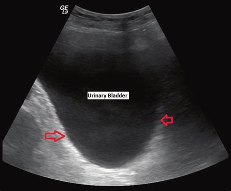 Normal Bladder Ultrasound