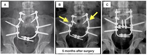 Sacral Prosthesis Substitution As A System Of Spinopelvic