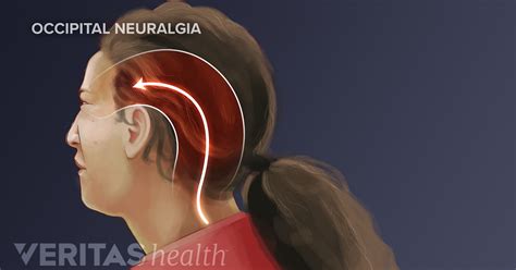 How To Deal With Occipital Neuralgia Get More Anythinks
