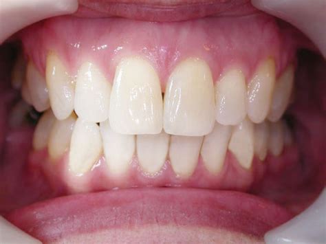 However, if a patient also has moderate to severe teeth misalignment, a dentist will recommend braces or aligners instead of dental bonding. Invisible Braces - Clover House Dental Practice