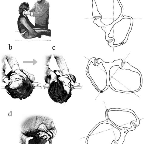 Yacovinos Maneuver For Leftright Acbppv A The Patient Is In The