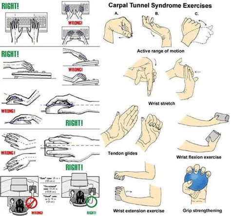 Carpal Tunnel Syndrome Ot Carpal Tunnel Syndrome Carpal Tunnel