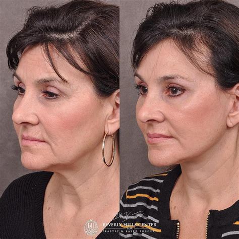 Auralyft Browlift Ptosis Repair Upper And Lower Blepharoplasty With