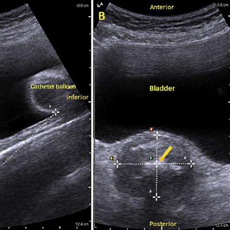 pdf comparison of measurements of the uterus and cervix obtained by magnetic resonance and
