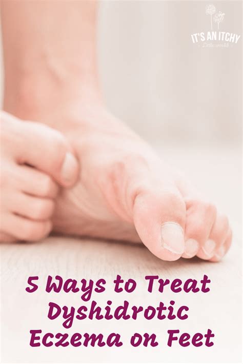5 Ways To Treat Dyshidrotic Eczema On Feet The Eczema Company Excema