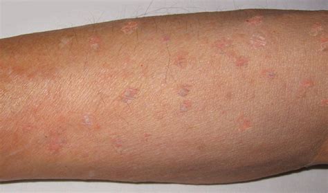 What Does A Lymphoma Skin Rash Look Like Stages Amp Treatment Okkii Com