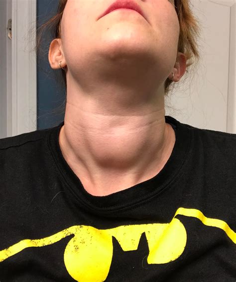 Persistent Goiter With Normal Labs Rhypothyroidism