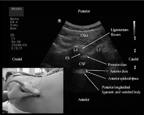 Table 2 From Real Time Ultrasound Guided Paramedian Epidural Access