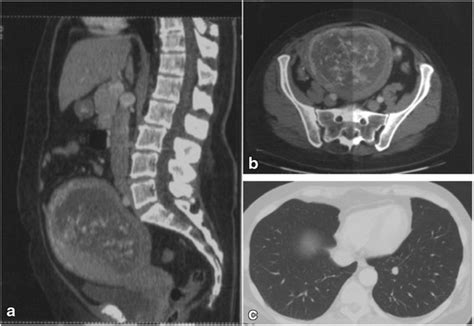 Abdominopelvic Contrast Enhanced Ct Scans Showing An Enlarged Uterus