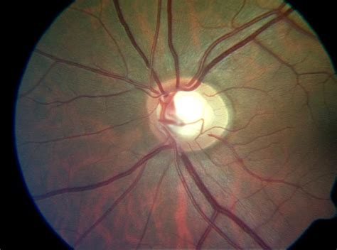 Glaucoma usually just quietly erodes their field of view, and typically people don't notice anything amiss until they start to stumble on things. Vilaplana - Dr. Daniel Vilaplana - Ophtalmology Center ...