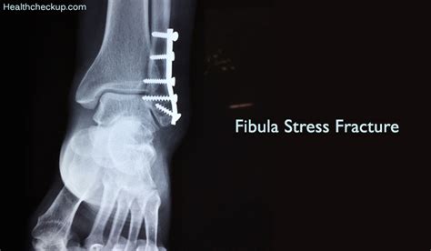 Fibula Stress Fracture Symptoms Causes Test Treatment Healing Time