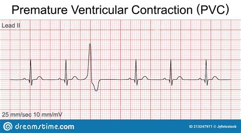Electrocardiogram Show Sinus Tachycardia Pattern Vector Illustration