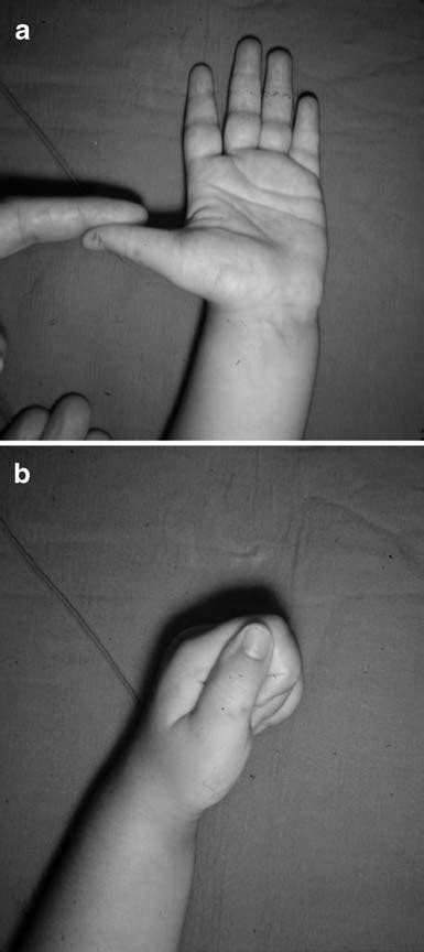 Z Deformity Of Thumb The Rheumatological System Basicmedical Key