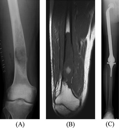 The Clinical Outcomes Of Total Femur Prosthesis In Patients With