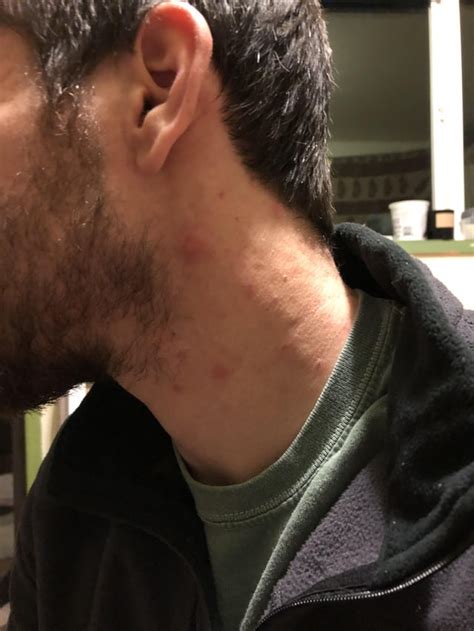 Acne Need Some Help With Cysts On My Neck Skincareaddiction