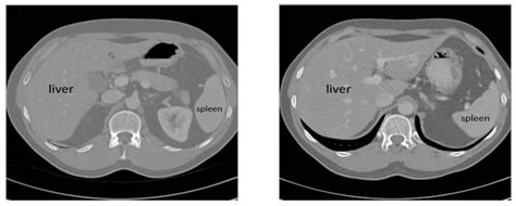 Sensors Free Full Text Liver Tumor Segmentation In Ct Scans Using