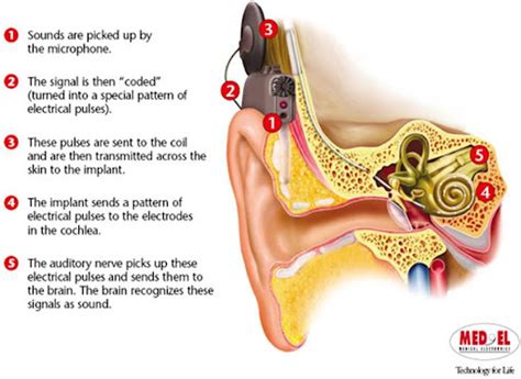 How Do Cochlear Implants Work New York Find The Answer Here