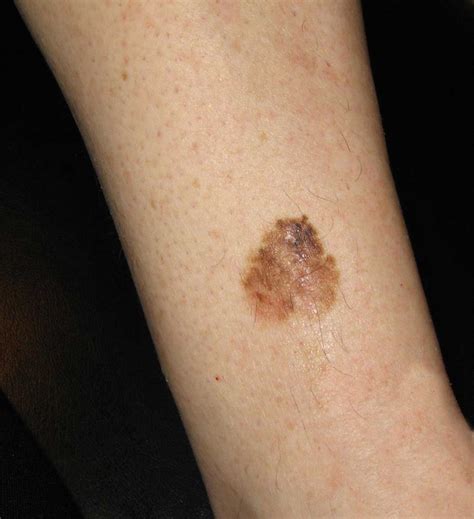 Melanoma Mm Marsden Skin Cancer Clinic