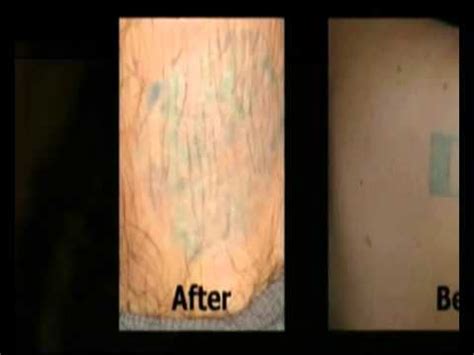 Best tattoo removal creams : Tattoo Removal Cream - YouTube