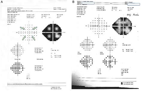 How To Interpret Visual Fields Practical Neurology