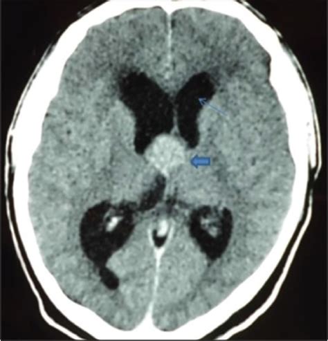 Contrast Enhanced Brain Ct Scan Showing A Well Defined Open I