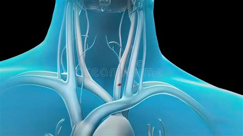 Pulmonary Embolism Blood Clotting Stock Illustration Illustration Of