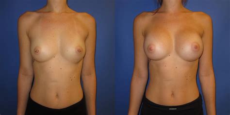 Breast Augmentation Before And After Pictures Case 237 Portland OR