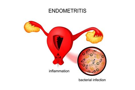 Chronic Endometritis Causes Symptoms Home Remedies Stdgov Blog