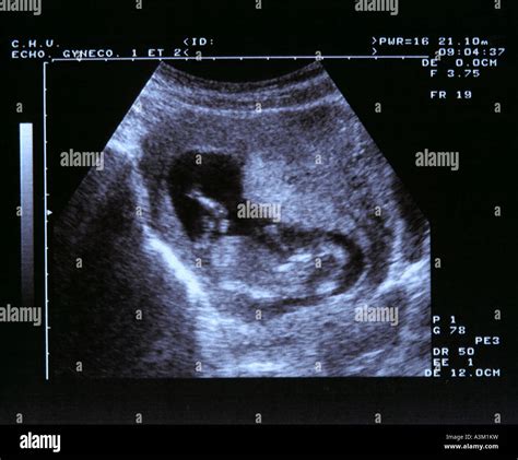 Blue Ultrasound Scan Of A 2 Months Old Foetus Stock Photo Alamy