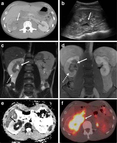 An Update On Burkitt Lymphoma A Review Of Pathogenesis And