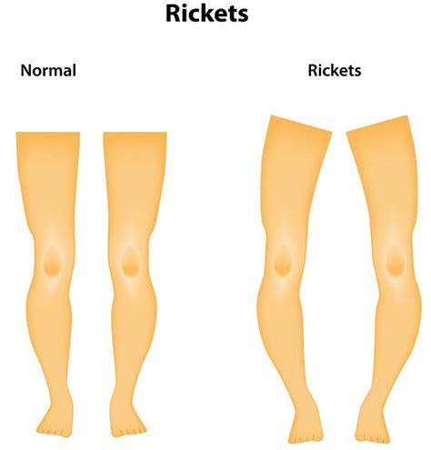 Rickets Symptoms Causes And Prevention Diseasefix