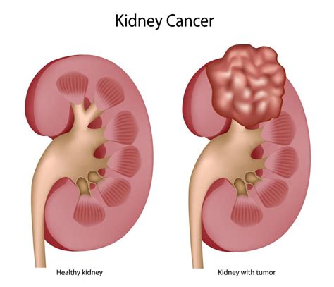 What Is Stage 4 Kidney Cancer With Pictures