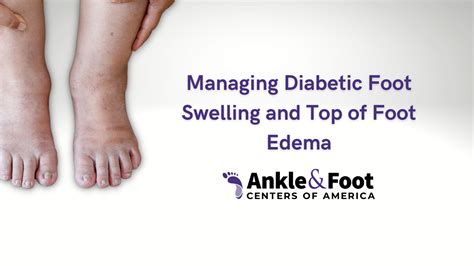 Diabetic Foot Swelling Swollen Feet From Diabetes